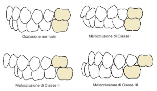 Classificazione di angle