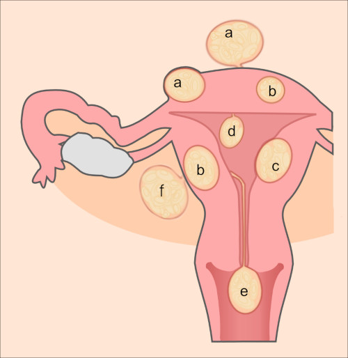 Leiomioma uterino