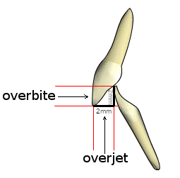 Overjet-overbite