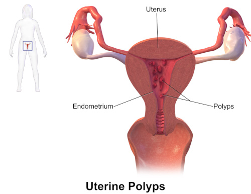 Polipo endometriale