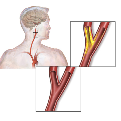 Stenosi arteria carotide