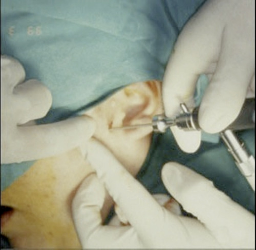 Artroscopia articolazione temporo-mandibolare